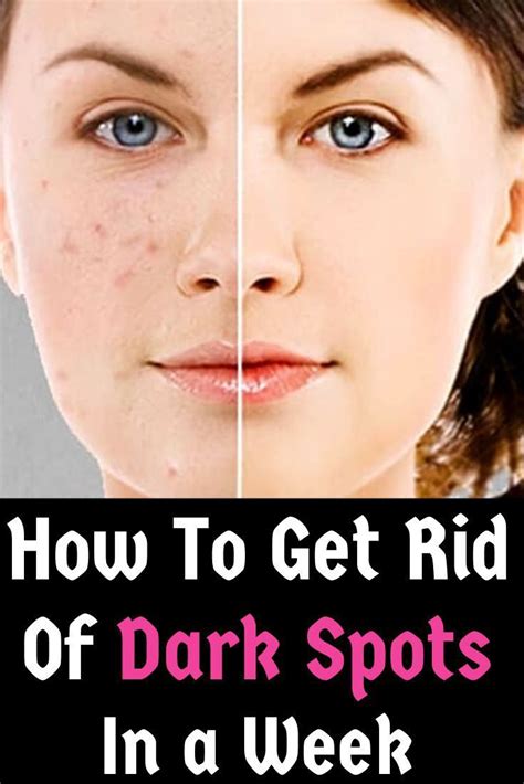 how to get rid of dark spots after shaving|More.